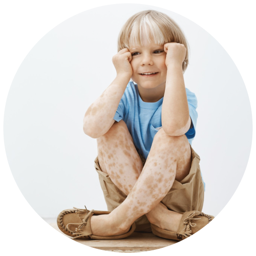 children-with-genetic-skin-diseases